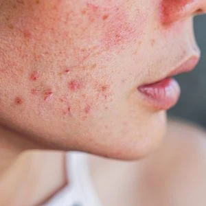 A close up image of a woman's face with pimples