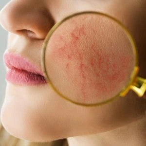 A photo of a magnifying glass on a woman's face revealing redness and dilated blood vessels
